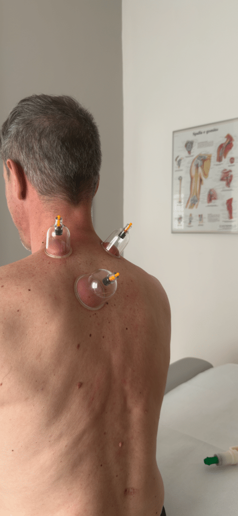 una persona con tre ventose sulla parte superiore della schiena sottoposta a coppettazione in un contesto clinico; una tabella anatomica evidenzia i benefici della coppettazione sulla parete.